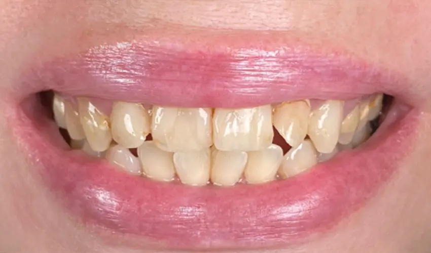 Before dental veneers transformation Las Vegas patient 3